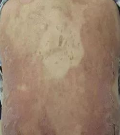 系统性红斑狼疮，干细胞治疗有效吗？