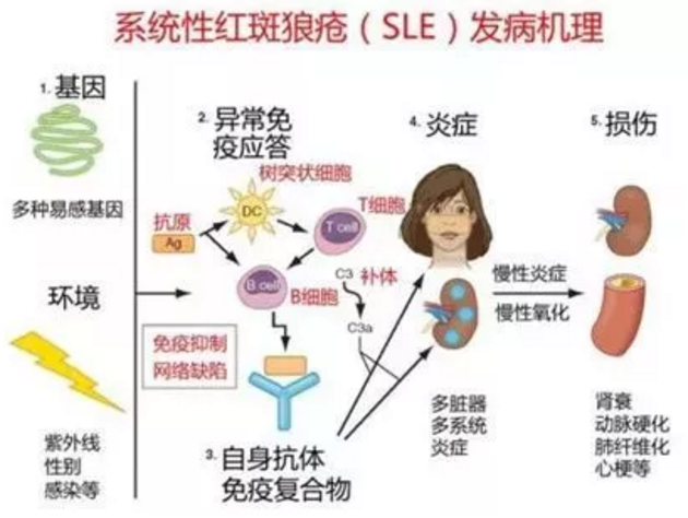 系统性红斑狼疮，干细胞治疗有效吗？