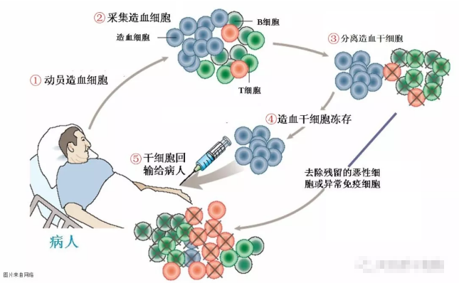 干细胞治疗系统性硬化病,安全且有效
