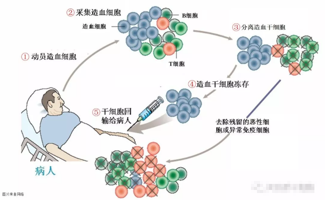 干细胞治疗系统性硬化病，安全且有效