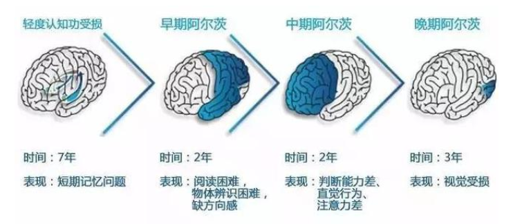 再生医学干细胞有效治疗阿尔茨海默病