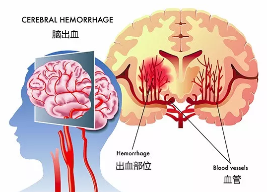 干细胞治疗神经系统疾病成功案例汇总