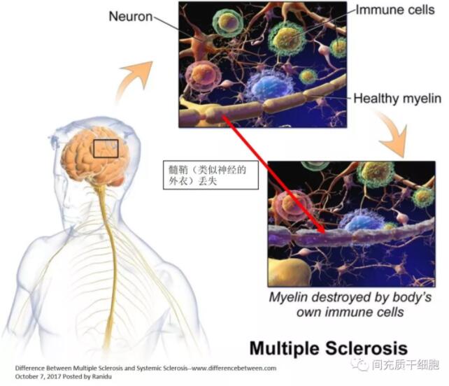 非常新钻研进展 | 干细胞医治多发性强硬症