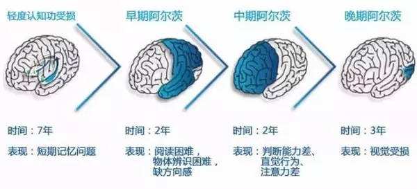 干细胞医治阿尔兹海默症（老年愚蠢）的近况及