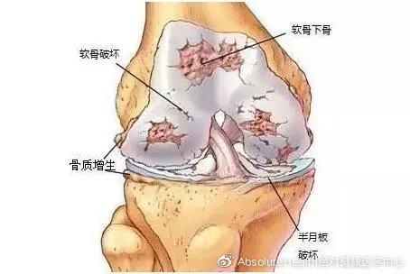 成功案例 | 再生医学疗法是如何治疗关节炎的？