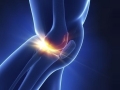 干细胞治疗让膝关节炎，让你的步伐更轻松！