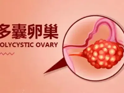 多囊调理，为何更需要个性化方案？