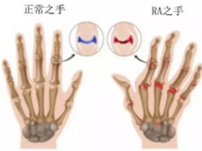 干细胞治疗类风湿性关节炎：改善疼痛和阻断恶